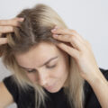 Close-up of a person's dry scalp showing signs of dryness and flaking