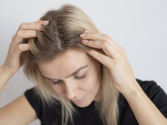 Close-up of a person's dry scalp showing signs of dryness and flaking