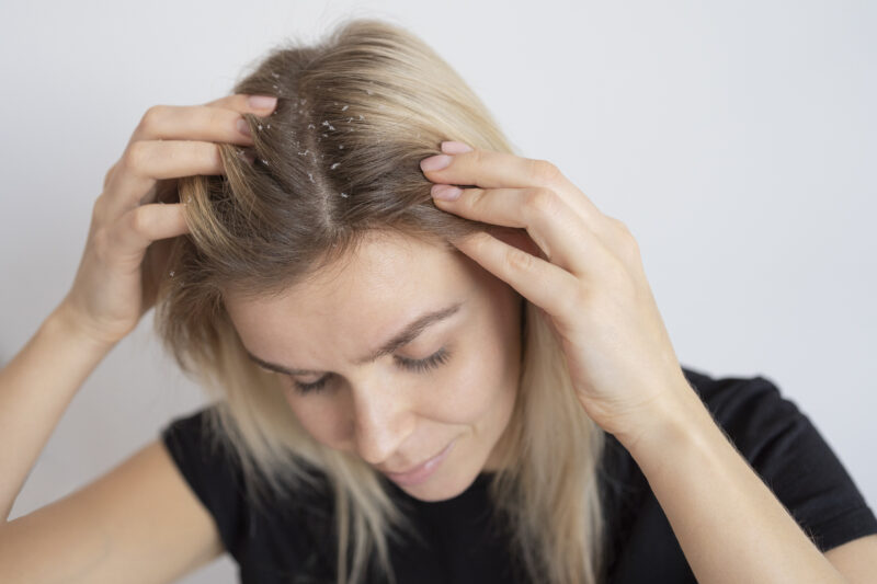 Close-up of a person's dry scalp showing signs of dryness and flaking