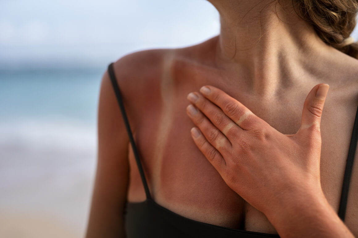 woman in the beach with sever skin Sun Damage