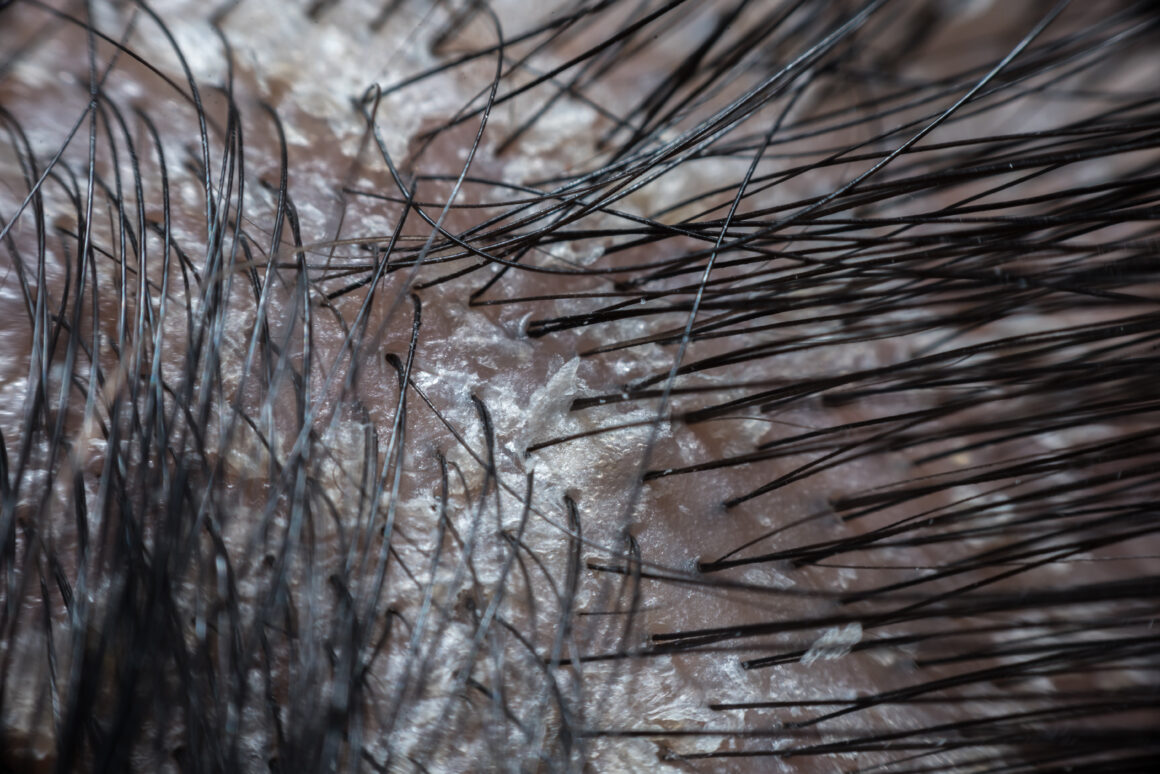 Close up Dry scalp with microscope